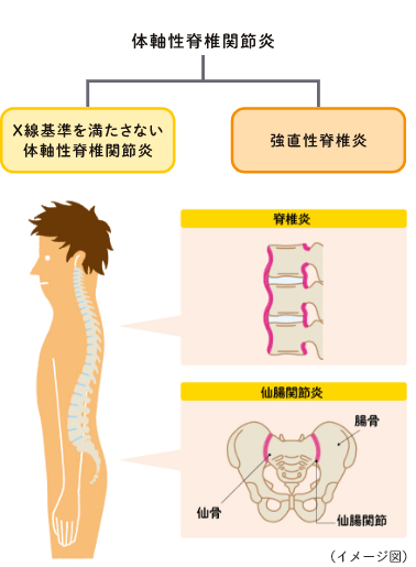 脊椎炎と仙腸関節炎の症状についての補足画像