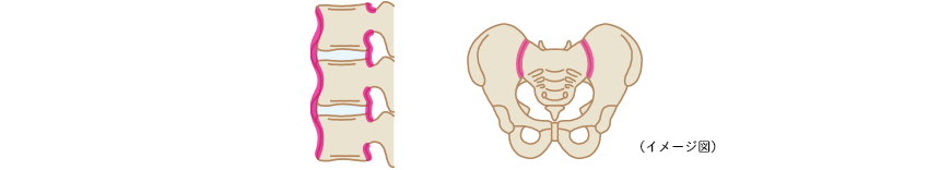 腰や背中、その他の関節の痛み骨の変化の補足画像