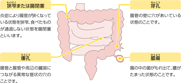 腸管でおこる症状（腸管合併症）