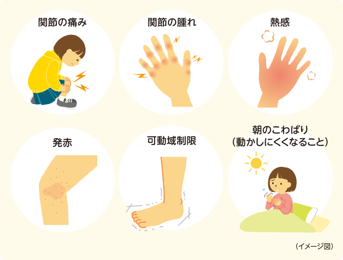 関節の痛み　関節の腫れ　熱感　発赤　可動域制限　朝のこわばり（動かしにくくなること）　イメージ図