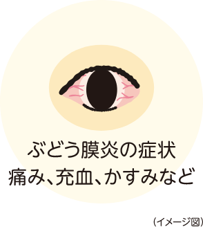 ぶどう膜炎の症状　痛み、充血、かすみなど　イメージ図