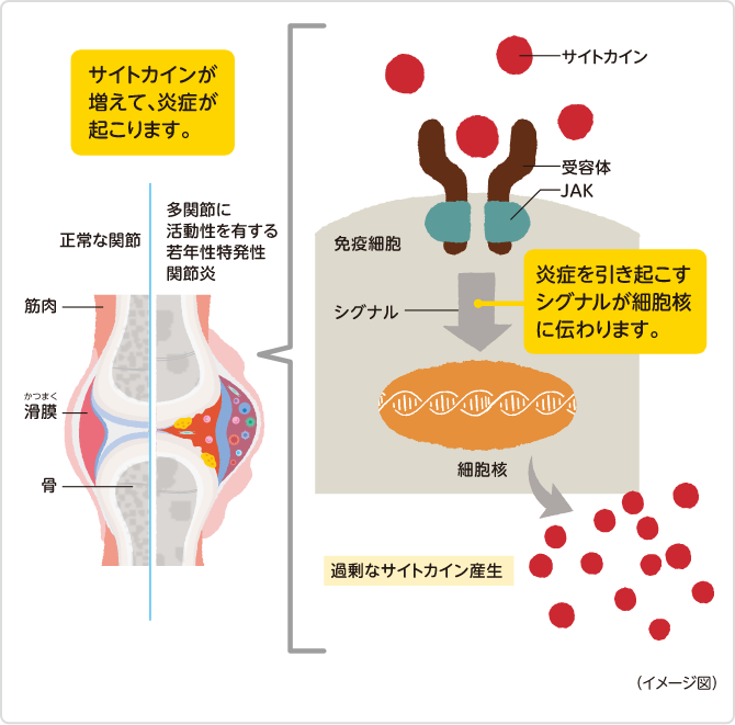 サイトカインが増えて、炎症が起こります。 炎症を引き起こすシグナルが細胞核に伝わります。　イメージ図