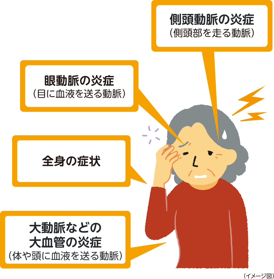 側頭動脈の炎症(側頭部を走る動脈) 眼動脈の炎症(目に血液を送る動脈) 全身の症状 大動脈などの大血管の炎症(体や頭に血液を送る動脈) イメージ図
