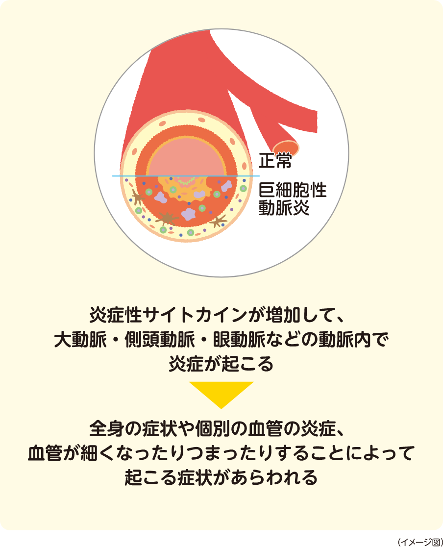 炎症性サイトカインが増加して、大動脈・側頭動脈・眼動脈などの動脈内で炎症が起こる ▶︎ 全身の症状や個別の血管の炎症、血管が細くなったりつまったりすることによって起こる症状があらわれる イメージ図