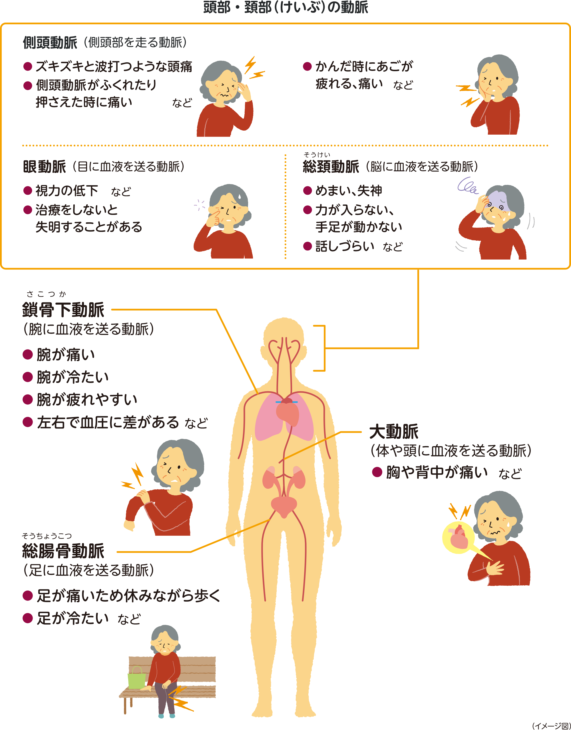 頭部・頚部(けいぶ)の動脈 側頭動脈(側頭部を走る動脈) ・ズキズキと波打つような頭痛 ・側頭動脈がふくれたりおさえた時に痛いなど 噛んだ時にあごが疲れる、痛いなど 眼動脈(目に血液を送る動脈) ・視力の低下など 治療をしないと失明することがある 総頸動脈(脳に血液を送る動脈) ・めまい、失神 ・力が入らない、手足が動かない ・話しづらいなど 鎖骨下動脈(腕に血液を送る動脈) ・腕が痛い 腕が冷たい ・腕が疲れやすい ・左右で血圧に差がある 大動脈(体や頭に血液を送る動脈) ・胸や背中が痛いなど 総腸骨動脈(足に血液を送る動脈) ・足が痛いため休みながら歩く ・足が冷たいなど イメージ図