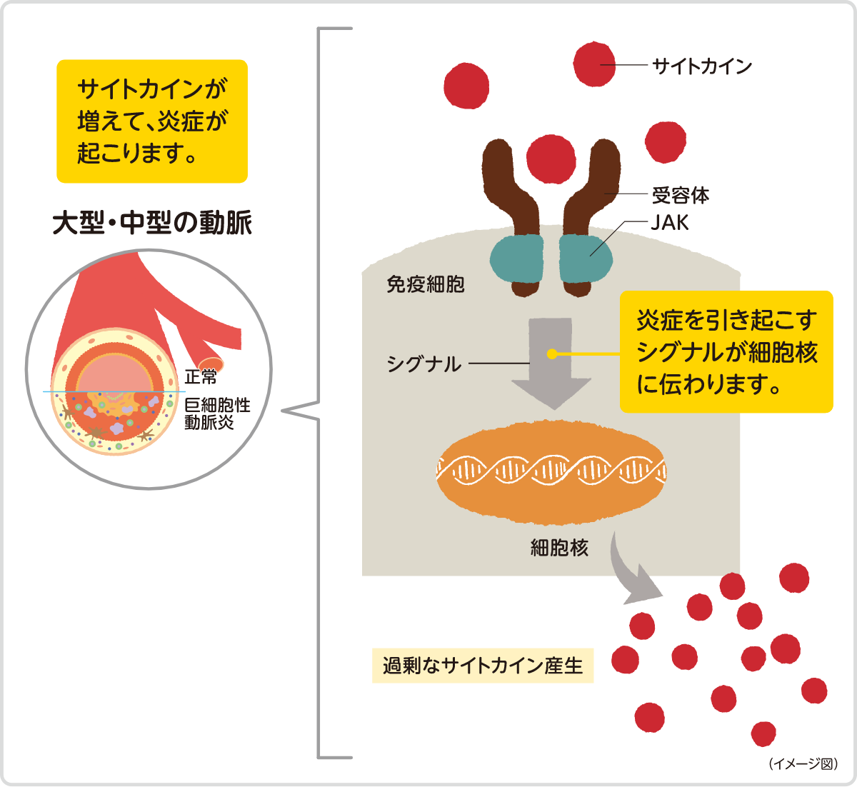 サイトカインが増えて、炎症が起こります。 炎症を引き起こすシグナルが細胞核に伝わります。　イメージ図